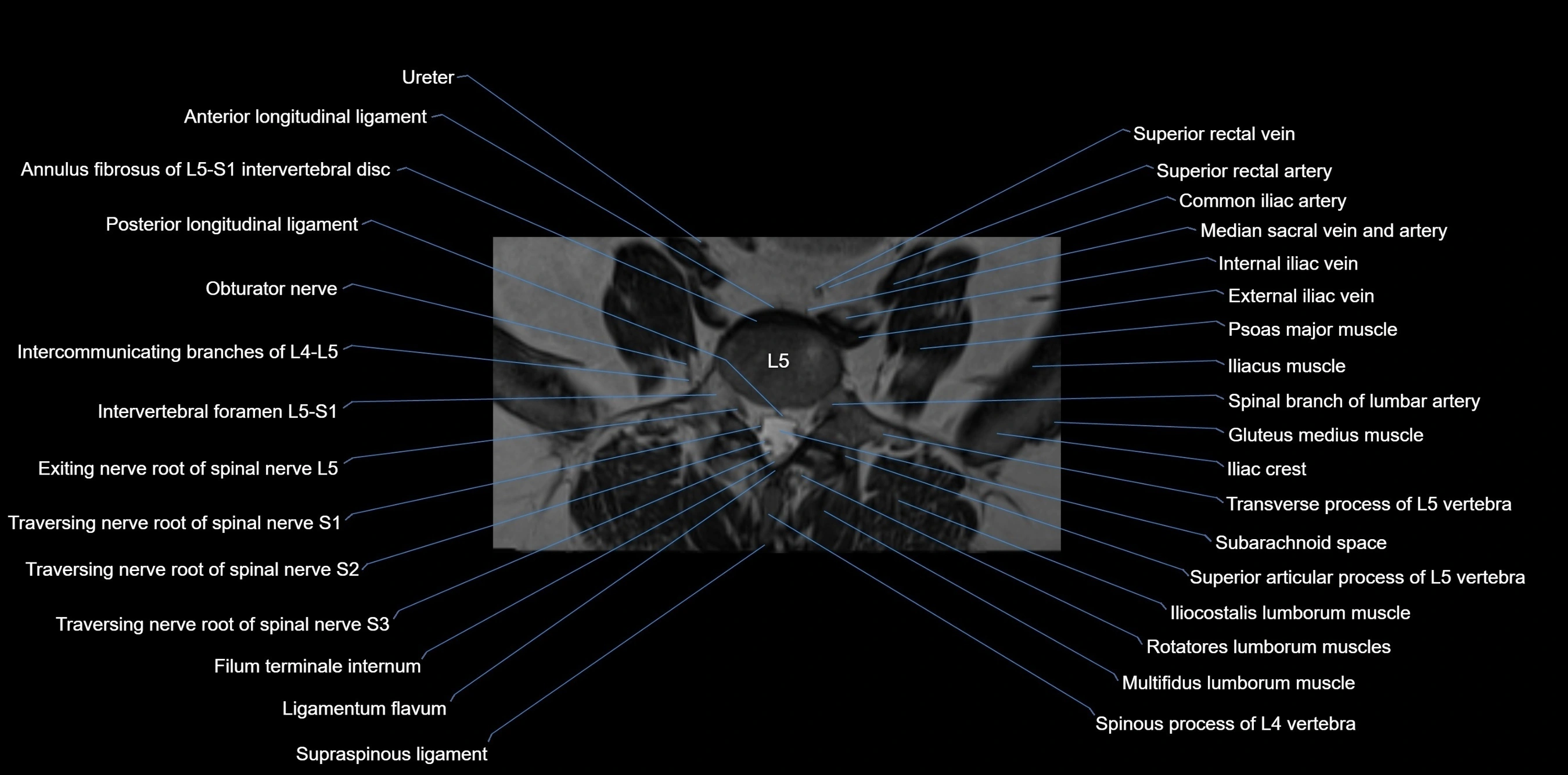 MRI sacrum, coccyx and sacroiliac joint axial cross sectional anatomy 3T  radiology  image-img-00001-00001.webp